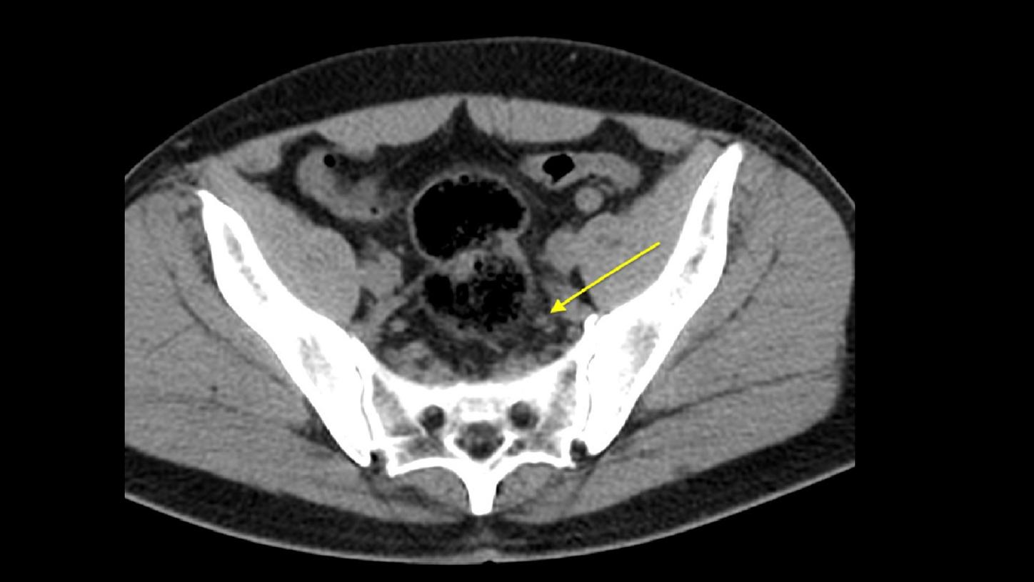 CT and PET/CT-fused axial images