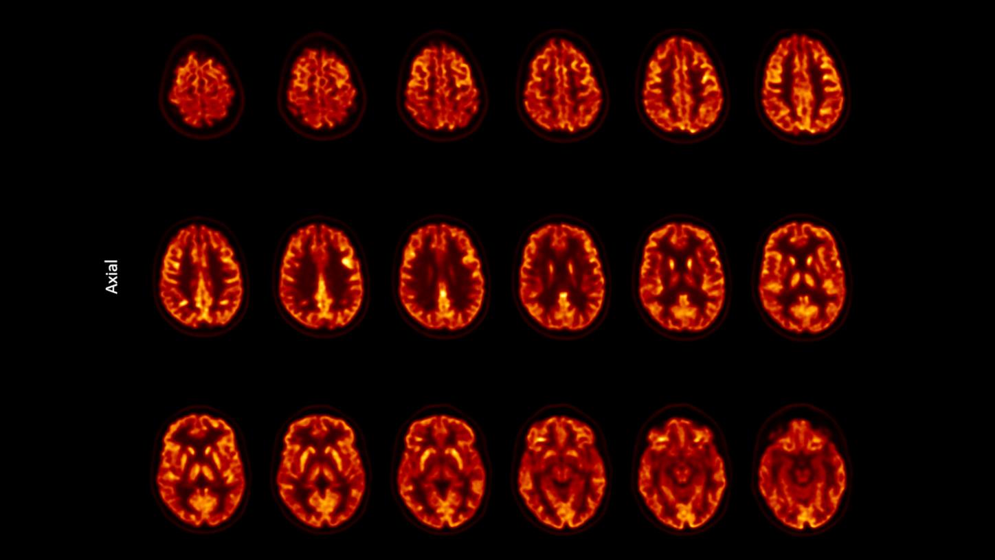 Brain scan for the assessment of cortical metabolism
