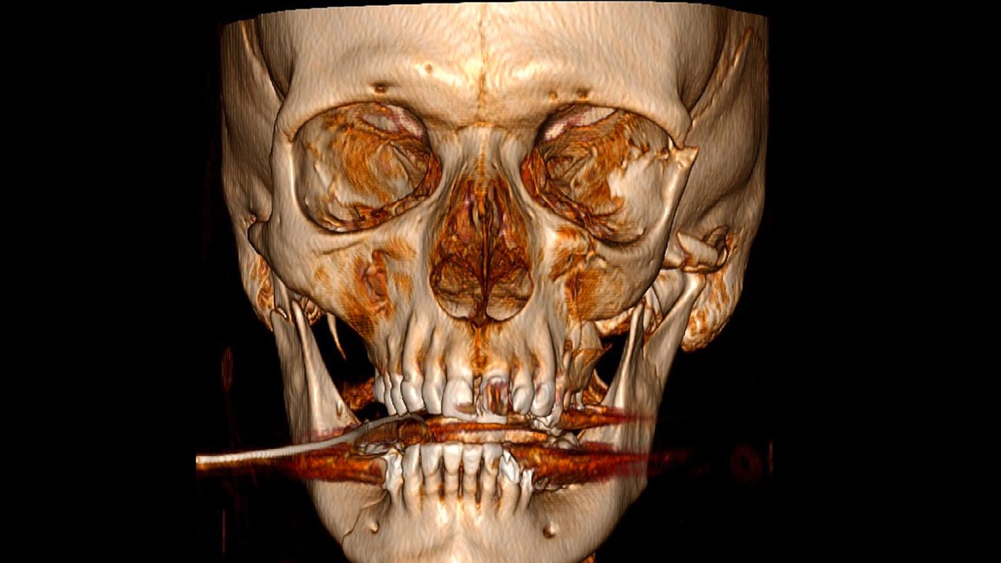 Fractura conminutiva panfacial compleja 01