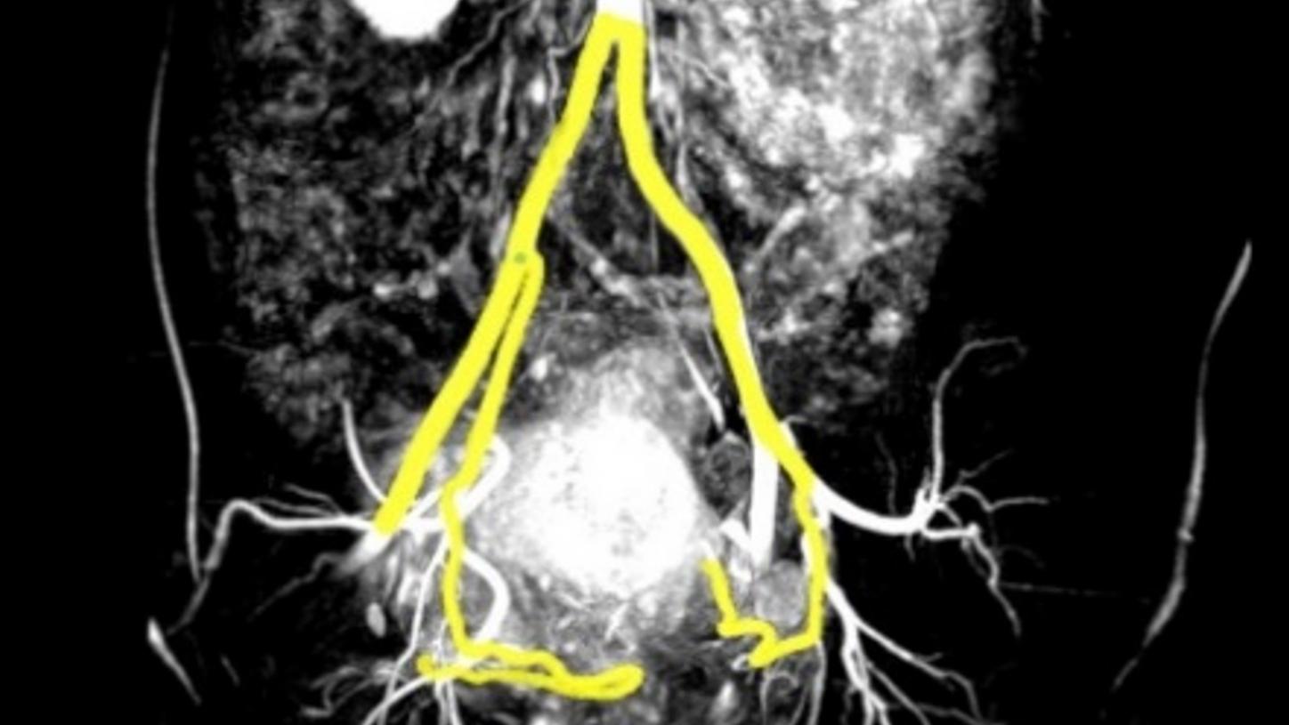 The flexible workflow setting allows you to manually mark the proximal and distal points for vessel detection.