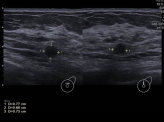 Image E: Ultrasound image showing a 0.7 cm round hypoechoic mass located in the mid-upper left breast, correlating with lesion 2 identified on the mammogram.