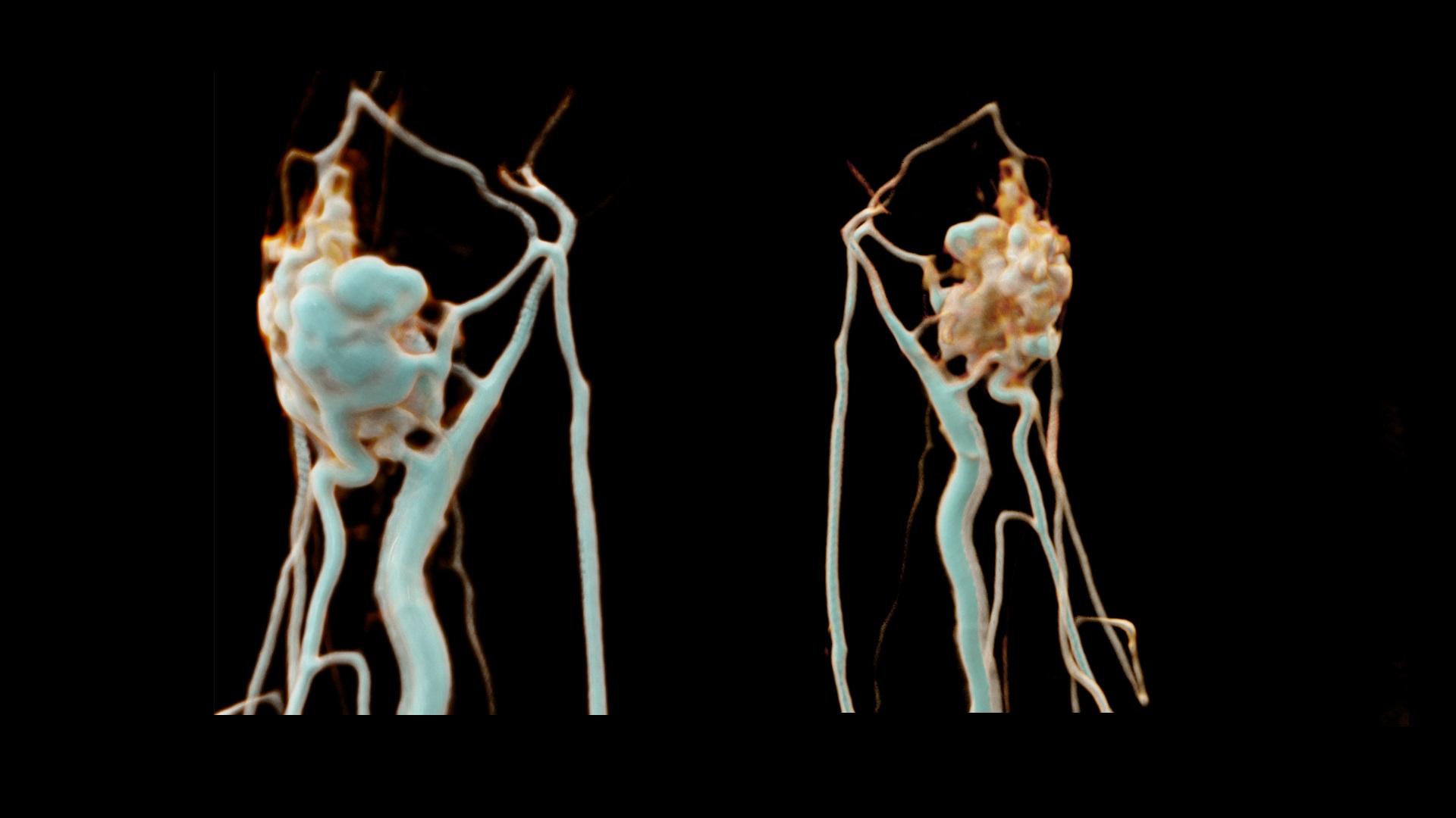 Subcutaneous arteriovenous malformation on the right wrist - Siemens ...