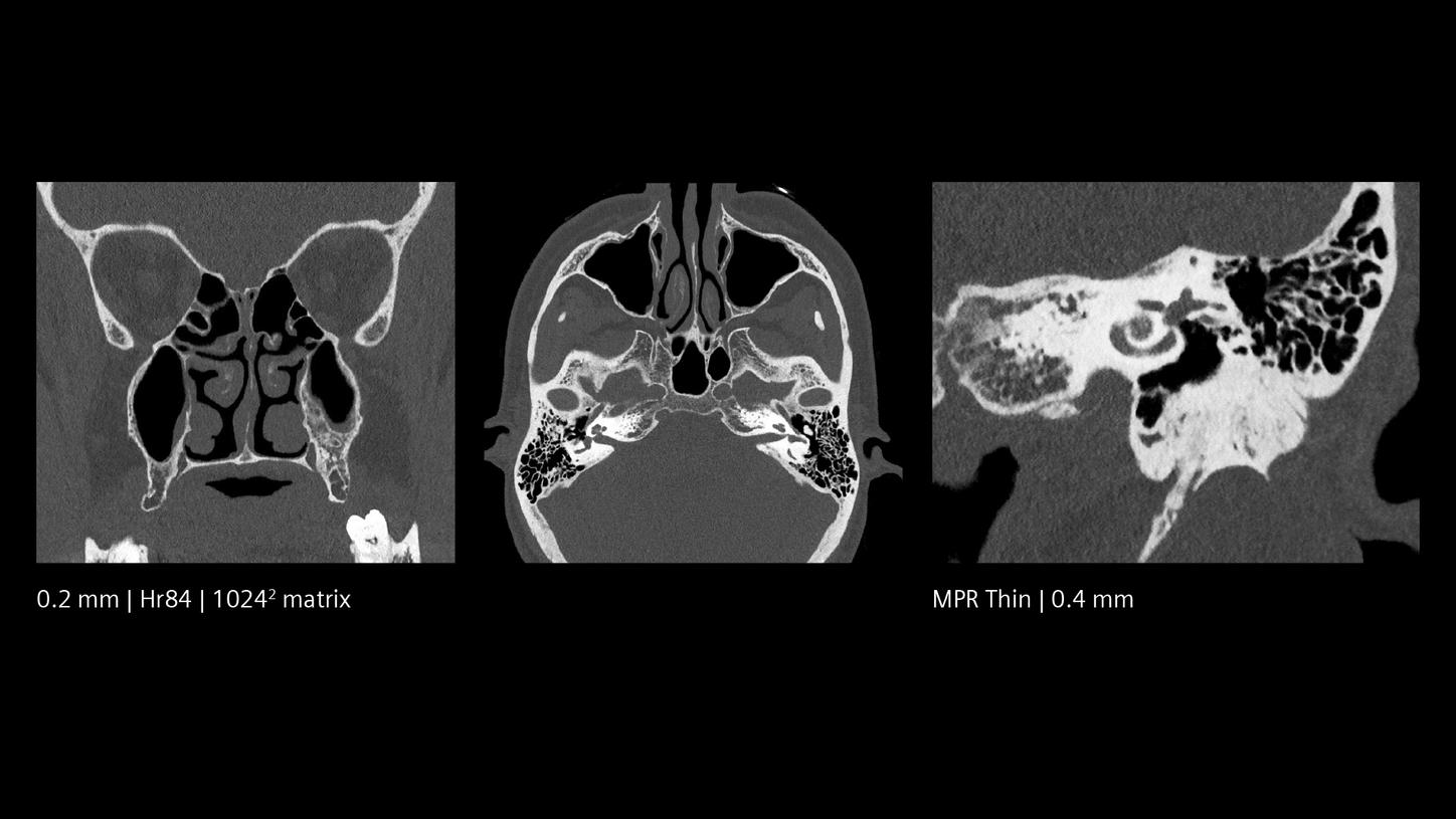 Low dose sinus PCCT – maintaining high image quality throughout the whole skull base.