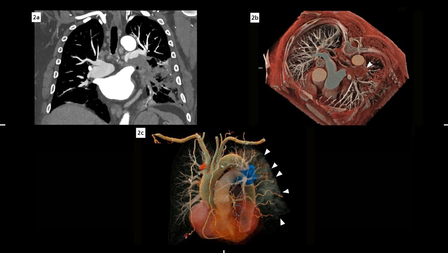 A filling in the lower part of the left pulmonary artery is shown on a coronal MIP image of the pulmonary vasculature and on a cross-sectional view of a VRT reconstruction of the pulmonary vessel arborization. Finally, an oblique view of a VRT reconstruction of the thoracic vessels shows the embolus highlighted in blue, and a cloud-like visualization of the consolidations in the left lung.
