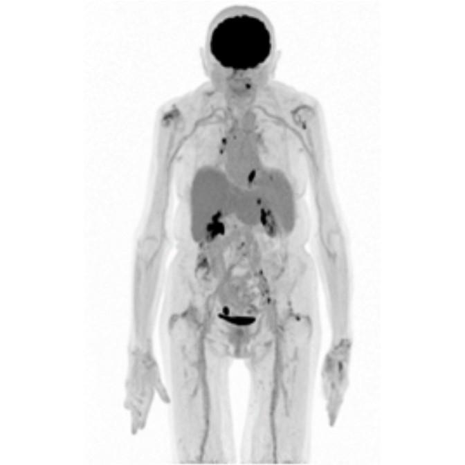 Oncology Indications Esophageal