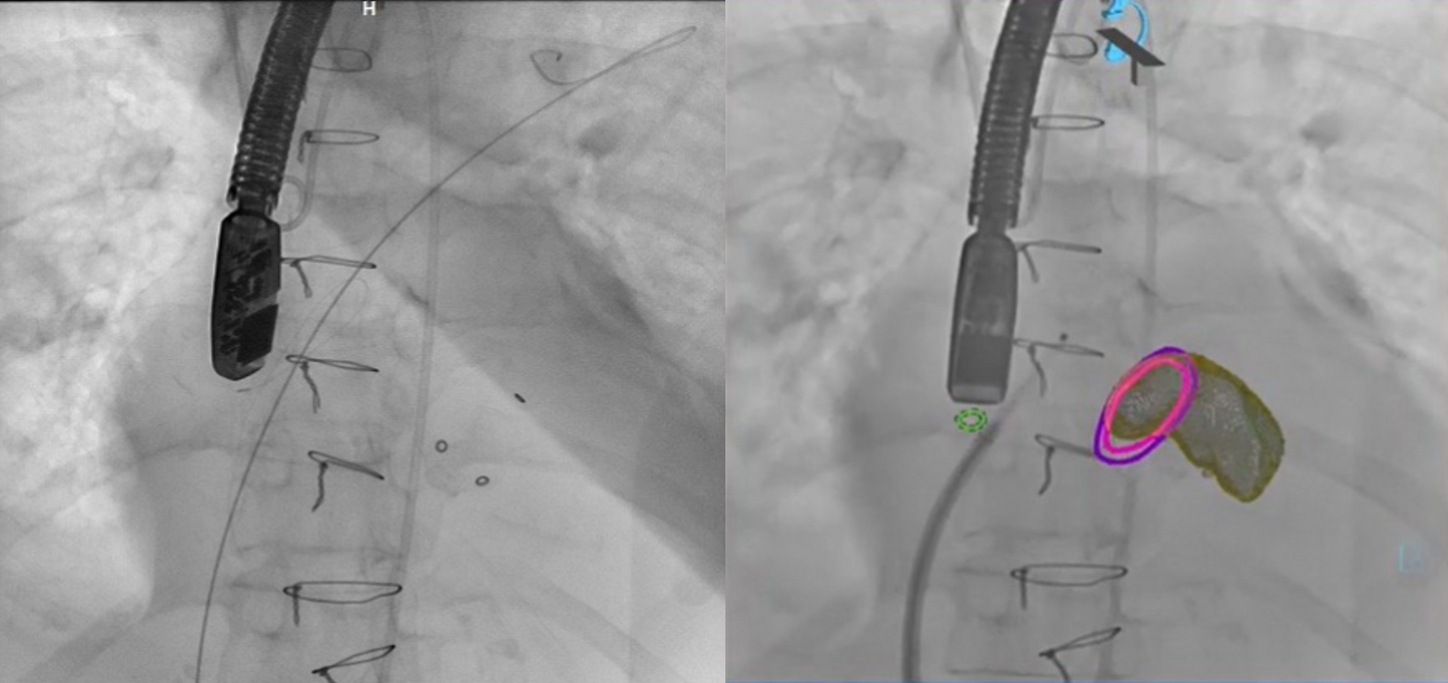 Transeptal puncture location planned pre procedure and overlayed on live fluoroscopy for precise puncture location with the help of syngo Fusion.