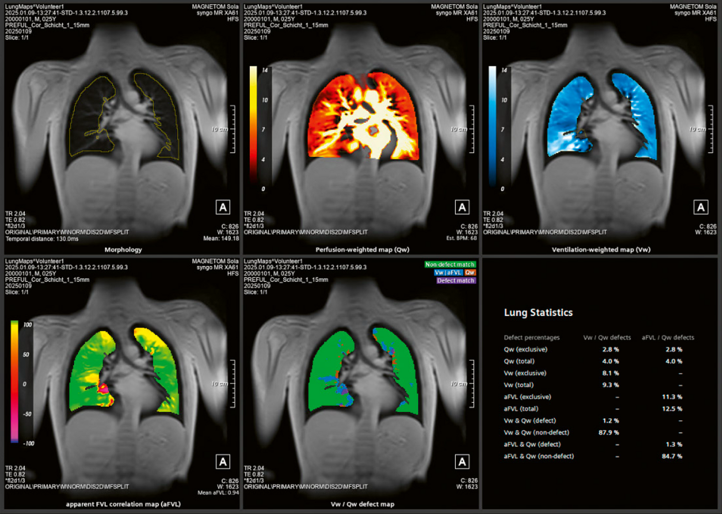 Siemens-healthineers_Magnetomworld_Lung_Maps_Portal