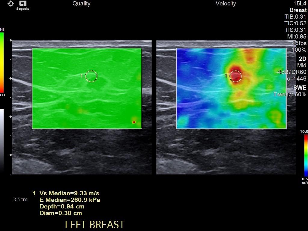 2D shear wave elastography on ACUSON Sequoia ultrasound