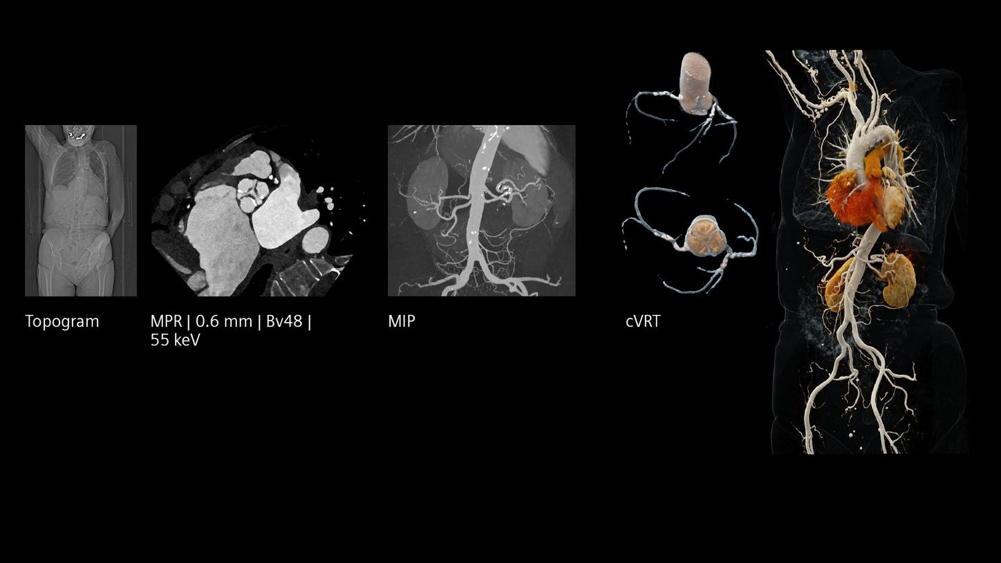 Clinical images: Topogram, MPR at 0.6mm slice thickness, MIP, and cVRT of an arm-down TAVI planning.