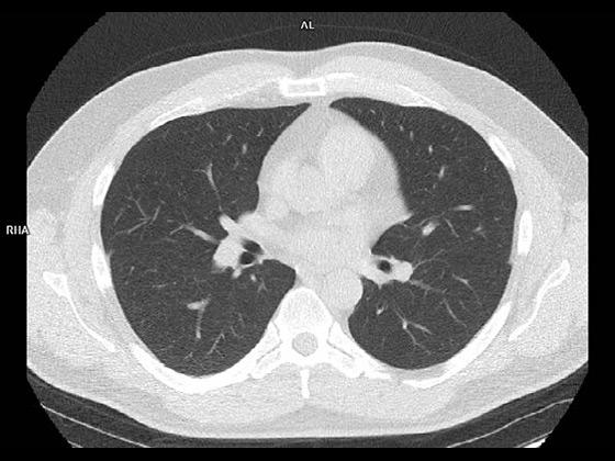Tin Filter Low Dose Lung Screening