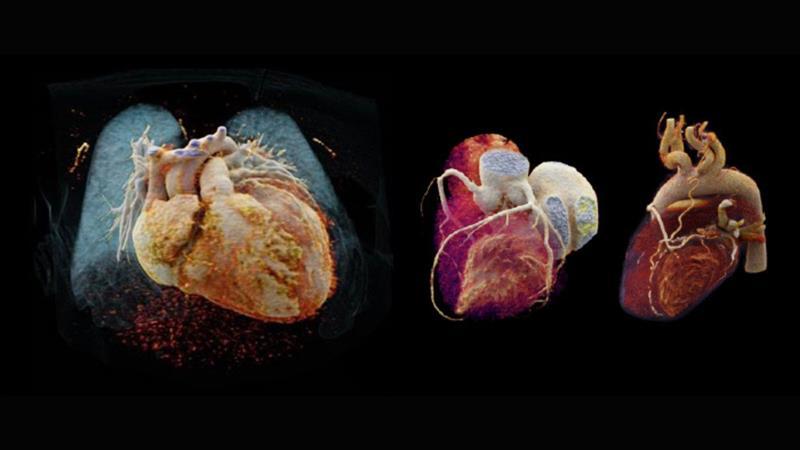 Clinical benefits for Dual Source Cardiac CT imaging