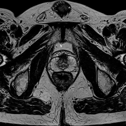 High Resolution Prostate Mri BioMatrix Technology - Siemens Healthineers India
