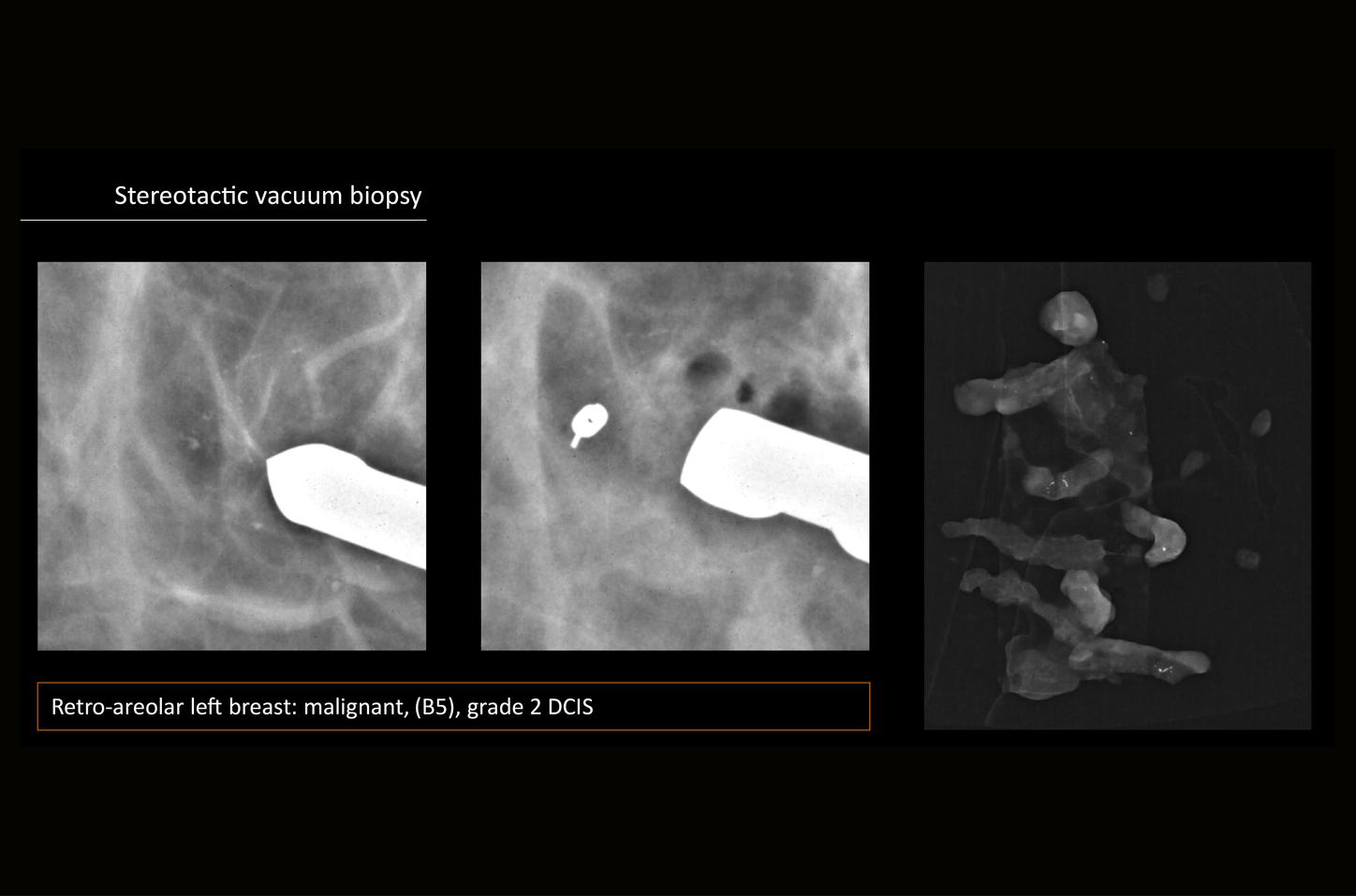 Microcalcificaciones pleomórficas en mama izquierda: diagnóstico de carcinoma ductal in situ grado 2