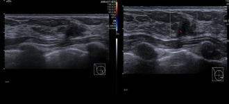 Image B: Ultrasound image shows an irregular hypoechoic mass with angular margins in the lower inner quadrant of the right breast.