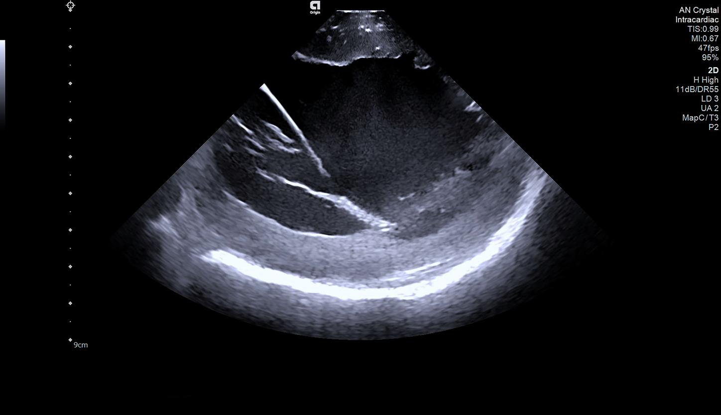 Clinical image on the AcuNav Crystal ICE catheter