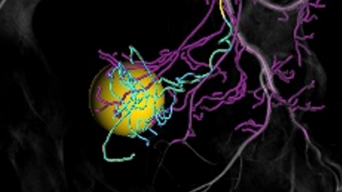 Easy length adaptation in the visualization of non-feeder vessels reduces information overload