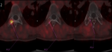 Fig 2: A suspicious focus in the right transverse process of T8. MRI of the thoracic spine confirmed metastatic involvement at T8 in the baseline study, with with follow up scan showing favourable response to SBRT, with interval metabolic lesional regression.