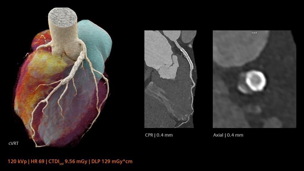 NAEOTOM Alpha - Applications cardiovasculaires - Siemens Healthineers ...