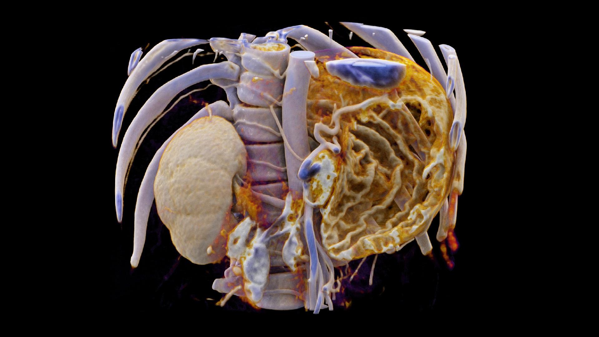Multiple gastrinomas Siemens Healthineers