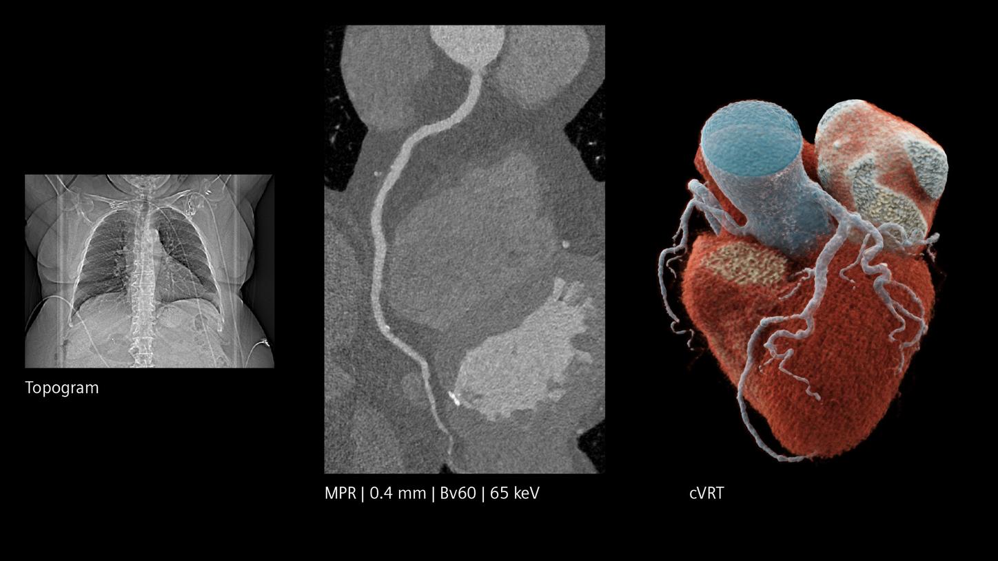 CT scan images of the chest and heart, including a 3D reconstruction of coronary arteries with scan details noted below.