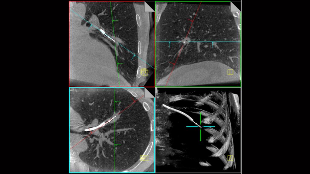 Diagnosis And Treatment Of Lung Cancer - Siemens Healthineers