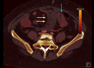 Fig. 6 : Comparative axial images between iodine mapping image and conventional CT scan image