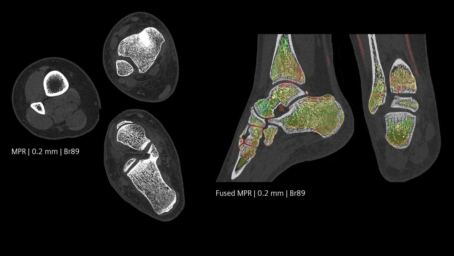 Photon-counting CT scan of an ankle with Quantum HD and Quantum Spectral Imaging