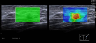 Image D: Elastography of the deep upper outer left breast mass demonstrates high stiffness, represented by a heterogeneous red area on the image, indicative of increased stiffness suggestive of malignancy.