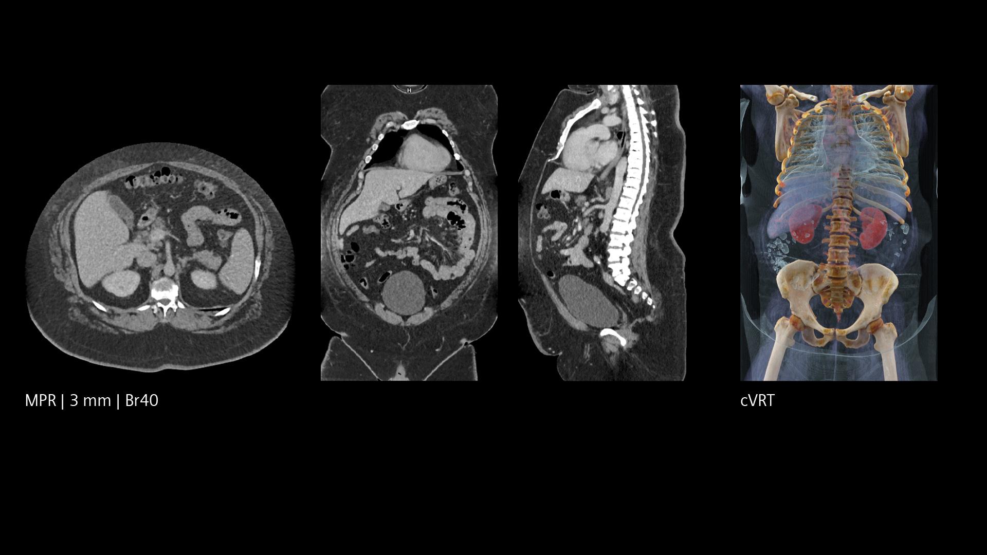 PCCT oncology imaging