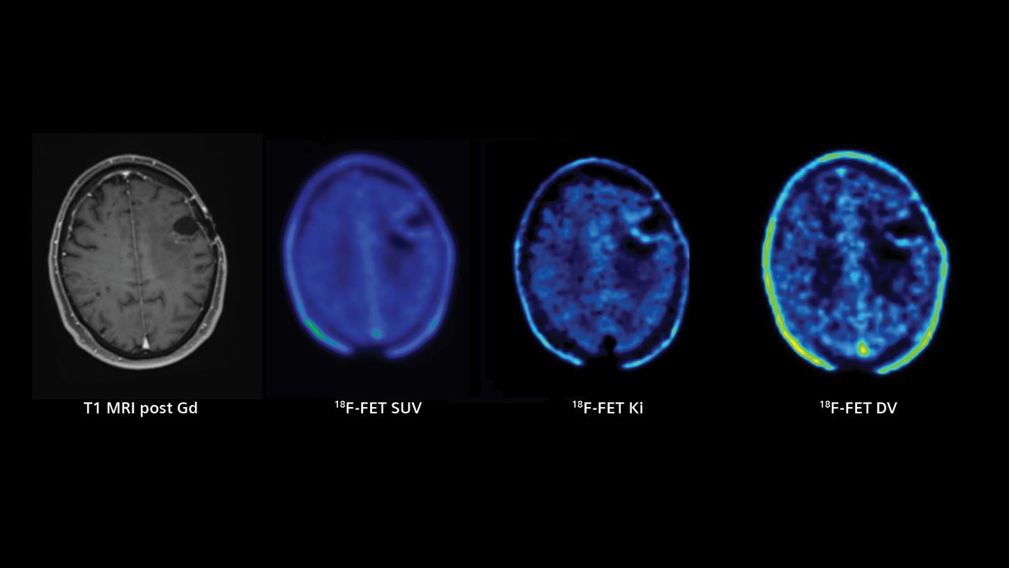 Differentiation of Glioblastoma
