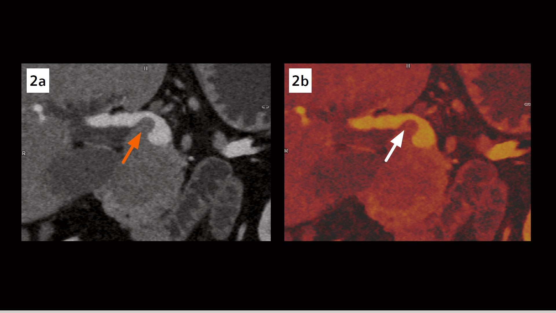 Atypical pancreatic neuroendocrine tumor secondary to metastatic renal ...