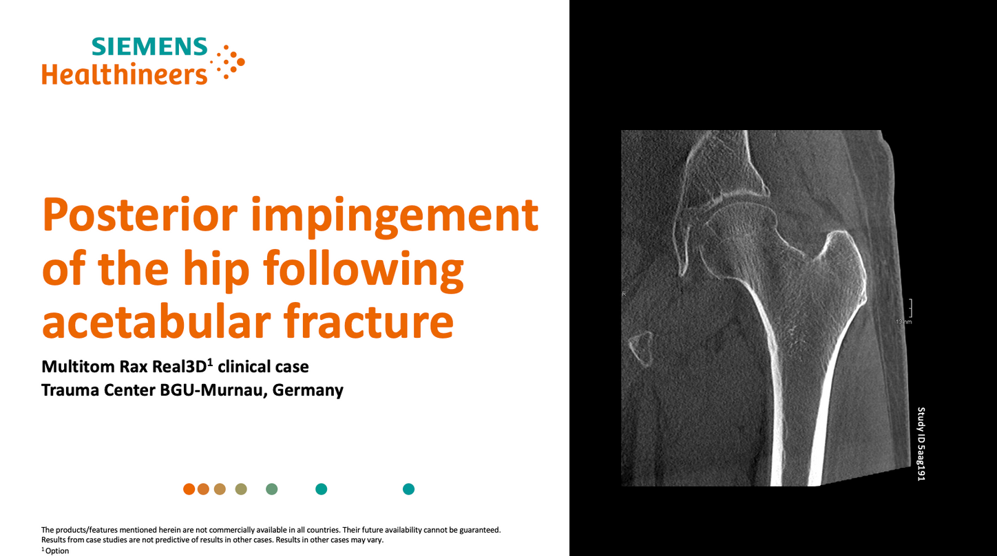 Posterior impingement fo the hip following acetabular fracture