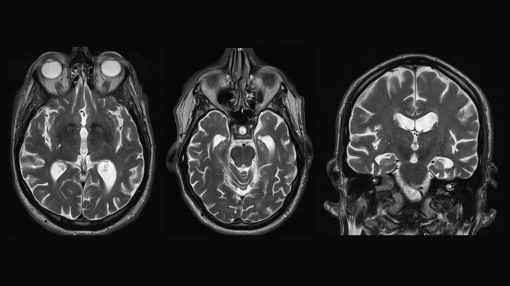 Beta-amyloid PET/CT imaging in the assessment of memory loss and ...
