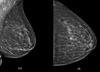 Image C: Mammogram images of the left breast, MLO and CC views, show focal asymmetry in the deep upper outer quadrant of the left breast, correlating with the ultrasound findings of lesion 1 (images A & B). There is also a round, isodense mass with obscured margins in the mid-upper left breast, middle third, corresponding to lesion 2.