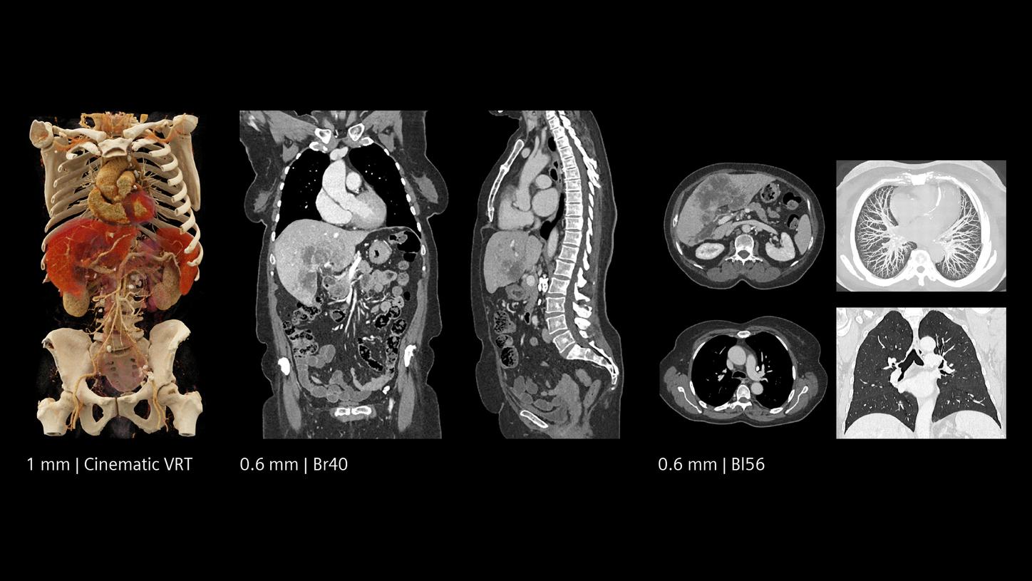 Whole-body scan and liver staging with outstanding sub-millimeter image quality at low dose for oncology assessment.