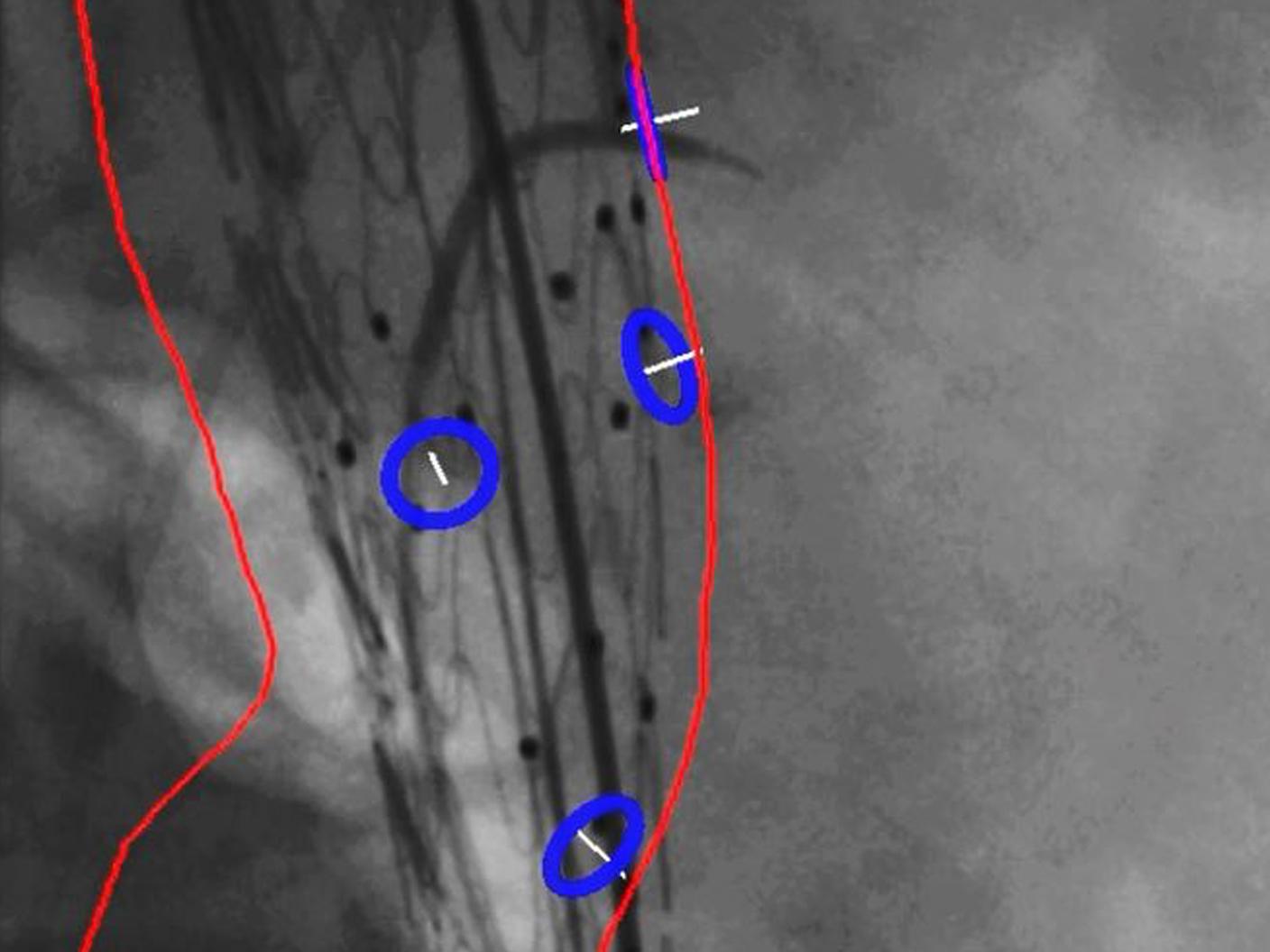 Precise guidance during stent deployment