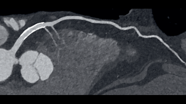 Together, photon-counting CT and cardiac MR form a synergistic imaging approach to cardiovascular care, combining structural and functional insights to refine diagnosis and guide management.