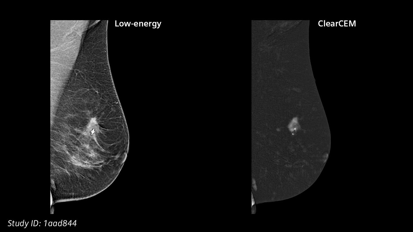 ClearCEM clinical case: Ductal carcinoma in situ