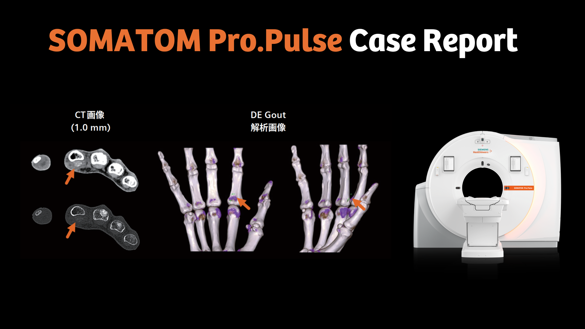 SOMATOM Pro.Pulse Case Report 3 -撮影線量の低減とDual Energy解析