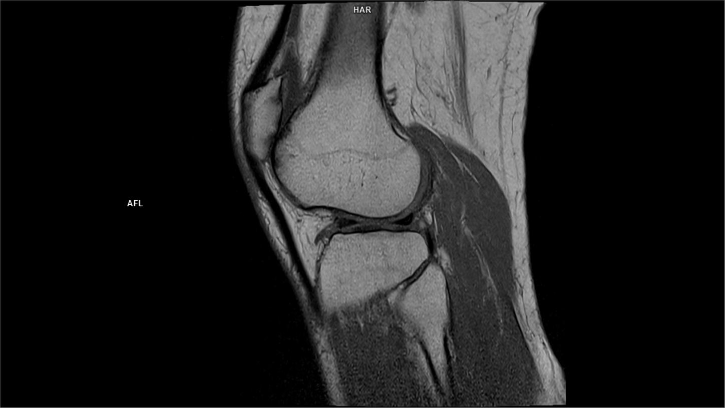 Sagittal T1-MAGNETOM Free.Max/Coil-Contour Small x2/Resolution-672/Scan Time-3:49/Aceleration-p2 DRS