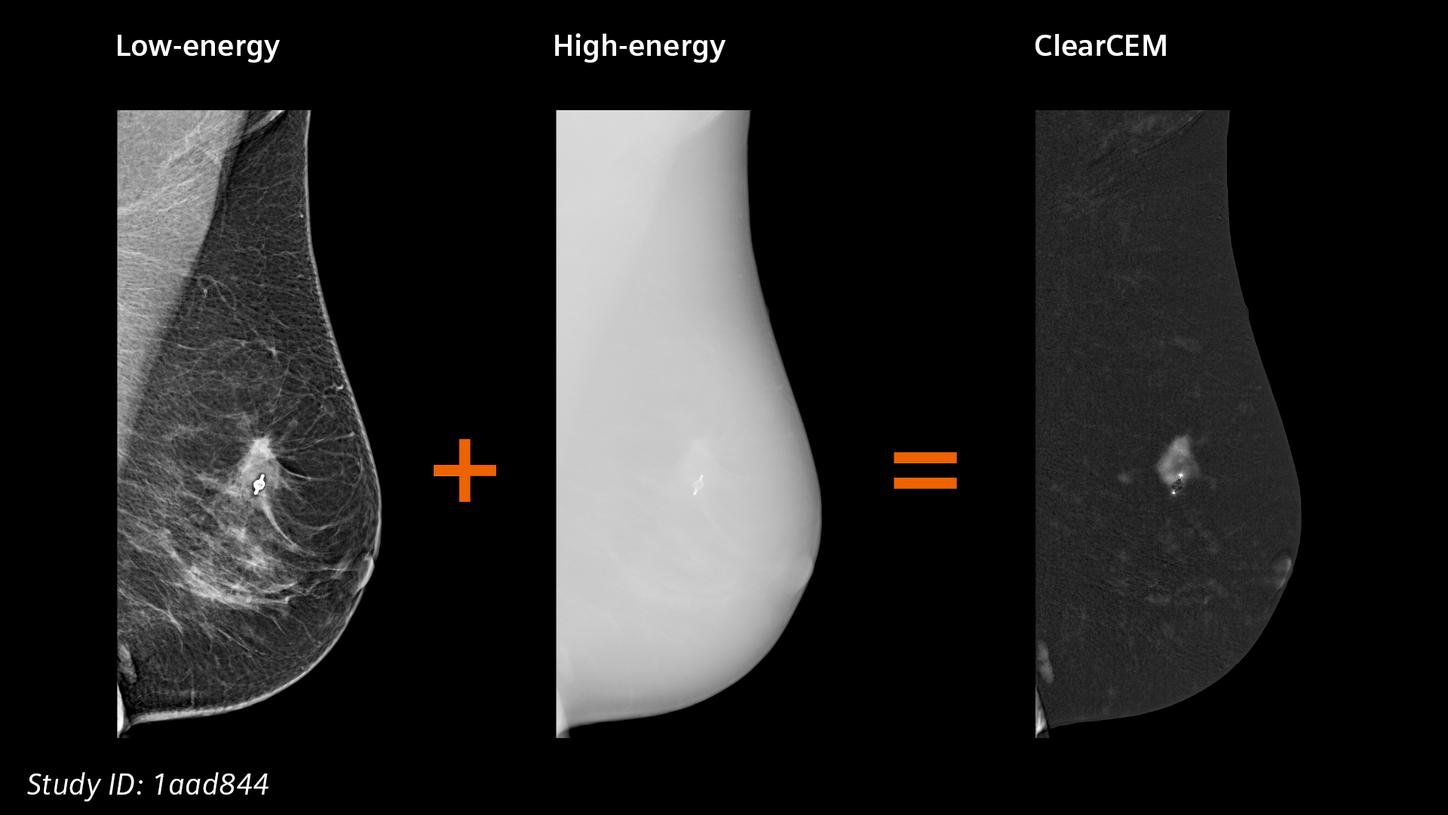 ClearCEM - Dual-energy mammography: the base for ClearCEM