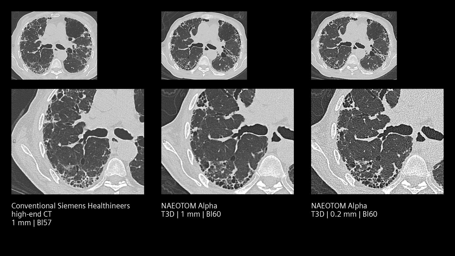 Comparison of conventional CT and NAEOTOM Alpha PCCT: Quantum HD resolution for lung fibrosis visualizes high details at low dose.
