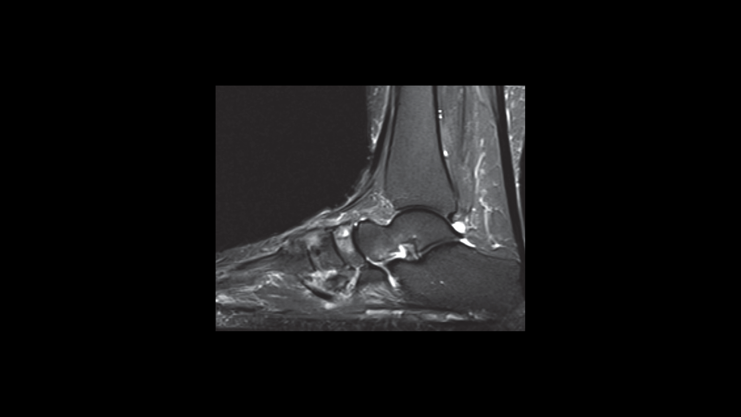 MRI of the right foot shows degenerative changes of the midtarsal joints.