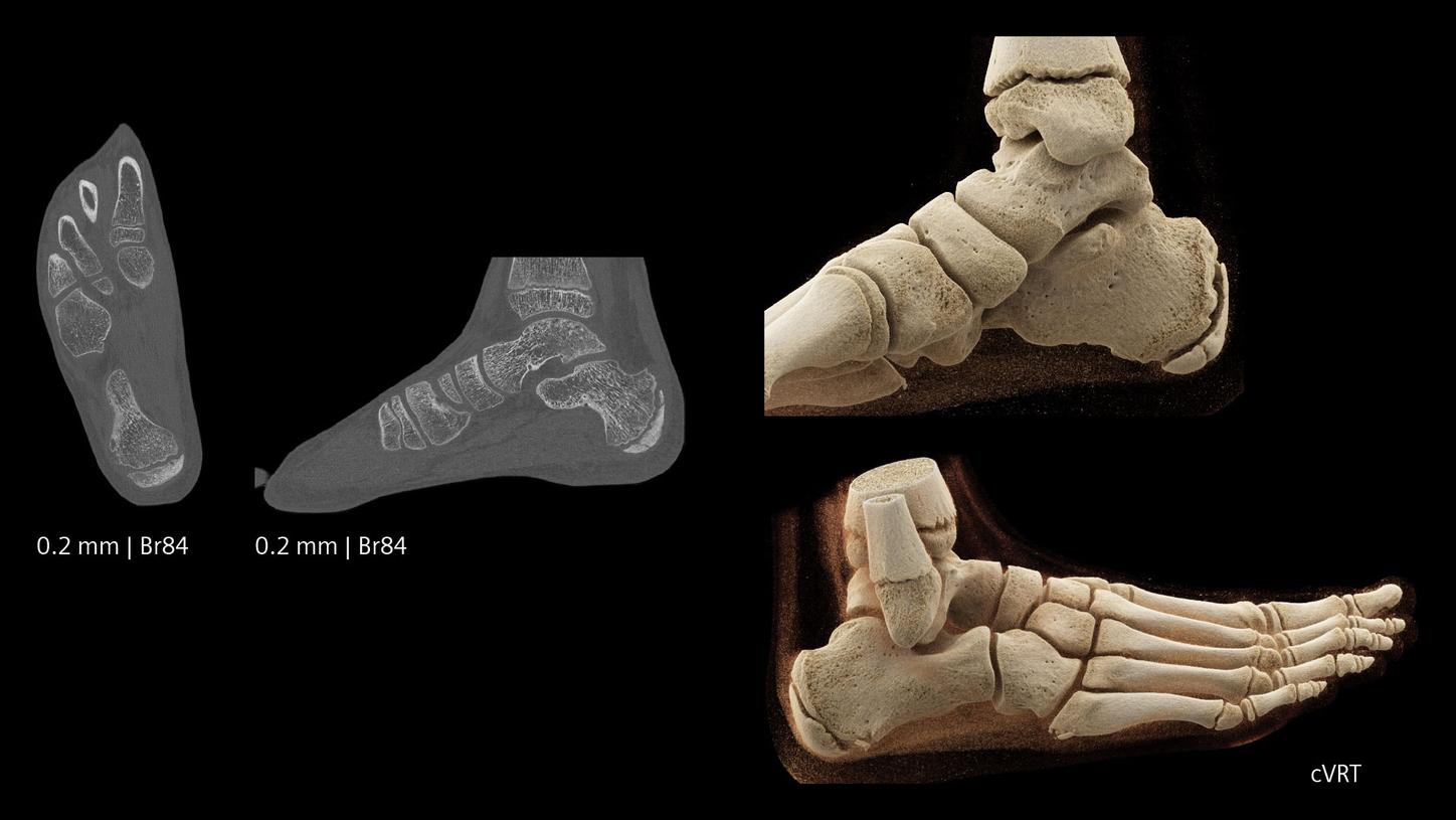 Pediatric CT low-dose foot imaging acquired by a NAEOTOM Alpha photon-counting CT. 