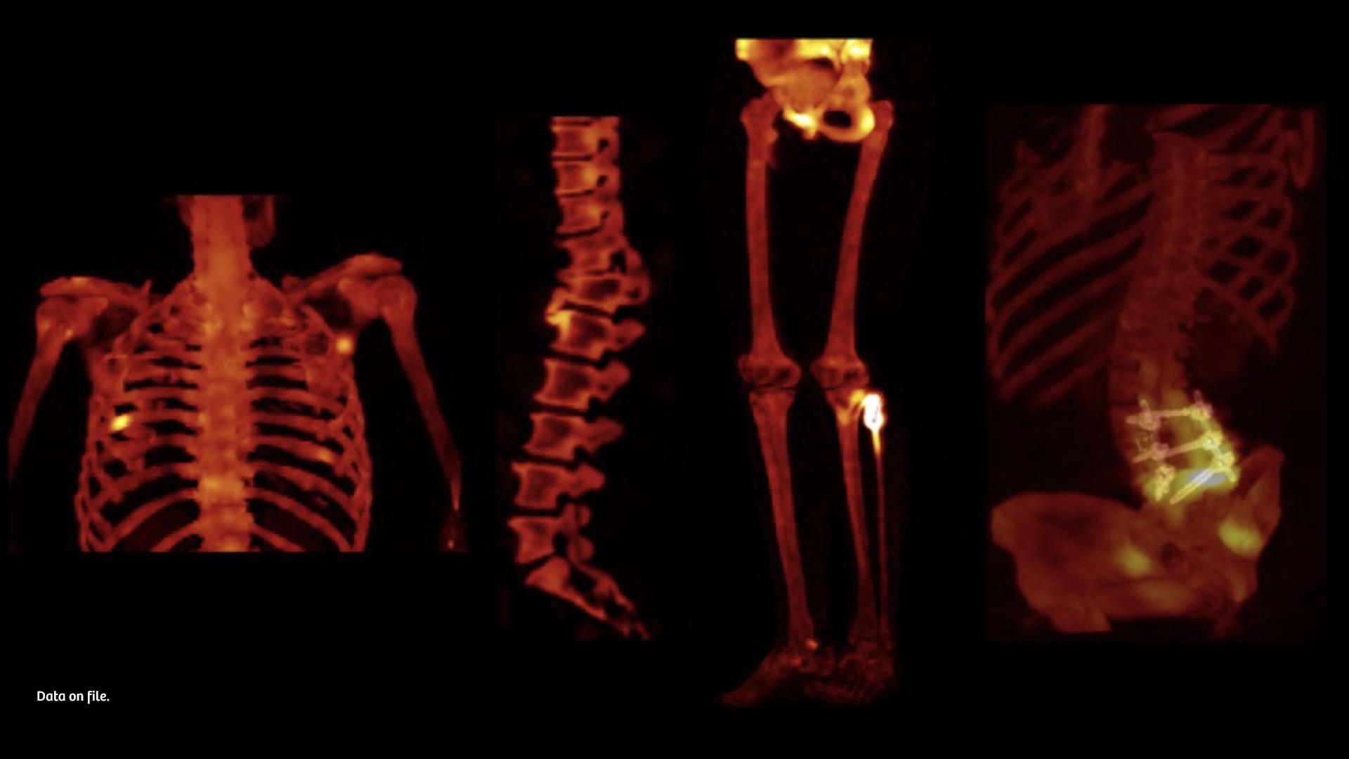 Moving SPECT/CT forward - Siemens Healthineers USA