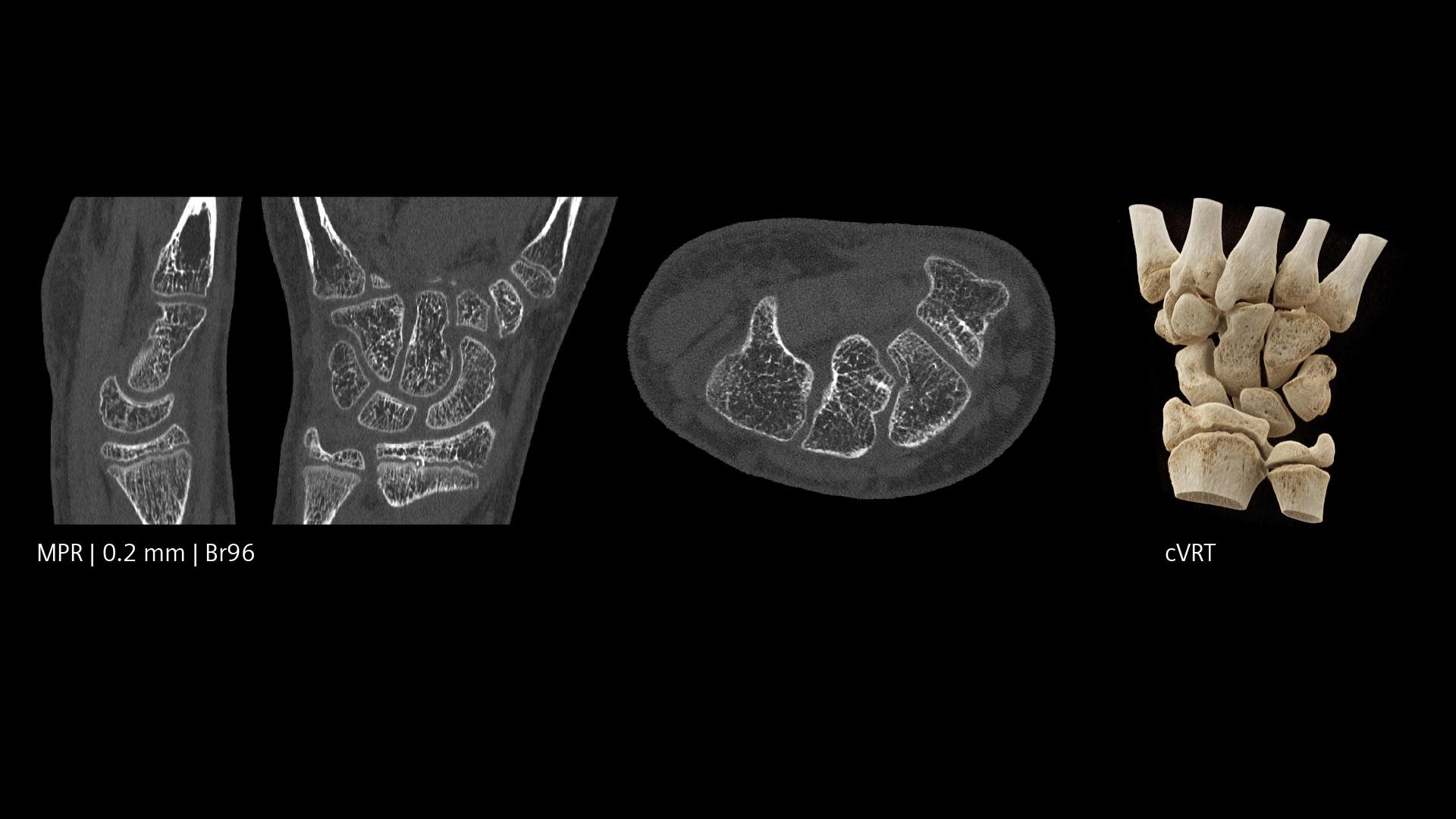 PCCT pediatric imaging - Siemens Healthineers USA