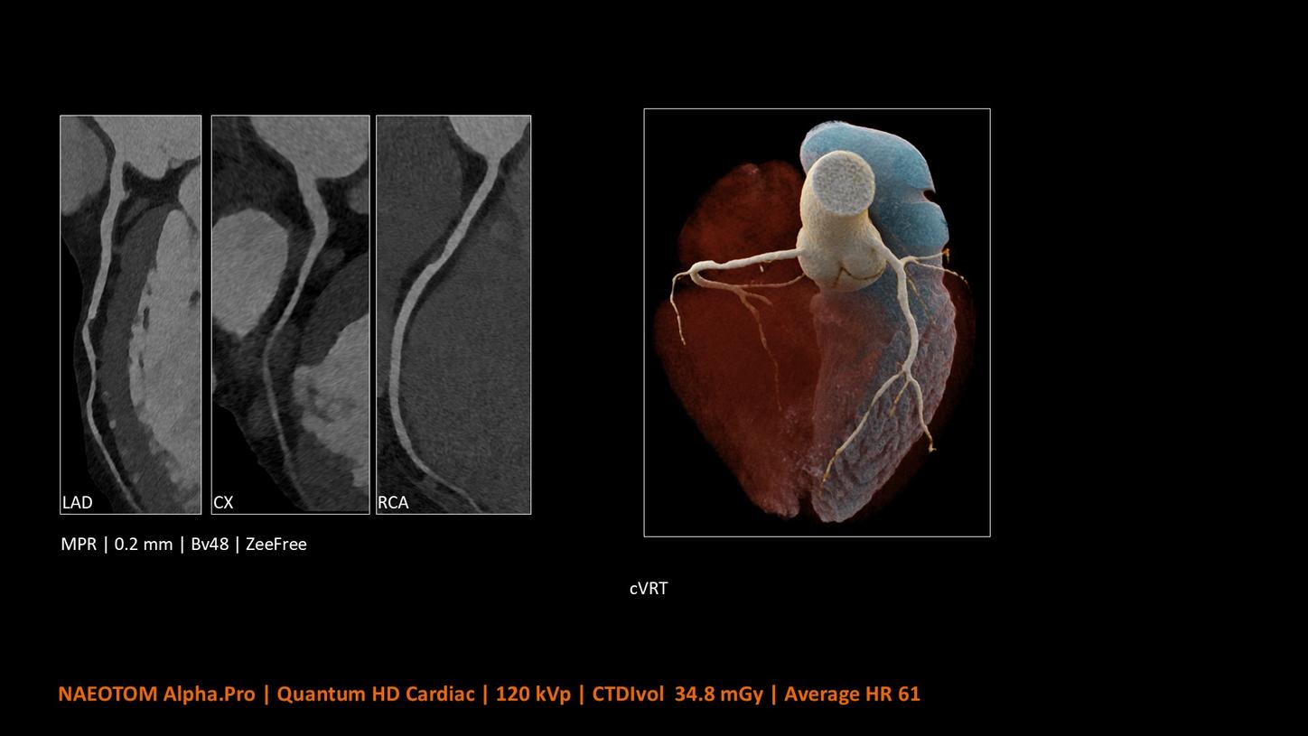 High-resolution cardiac CT images of coronary arteries and a 3D heart model, labeled LAD, CX, and RCA.