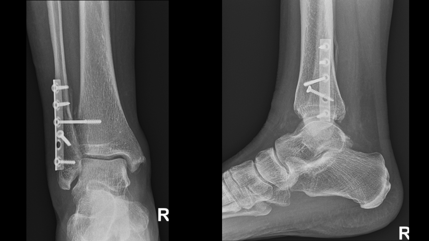 DI XP Luminos Qnamix Ankle