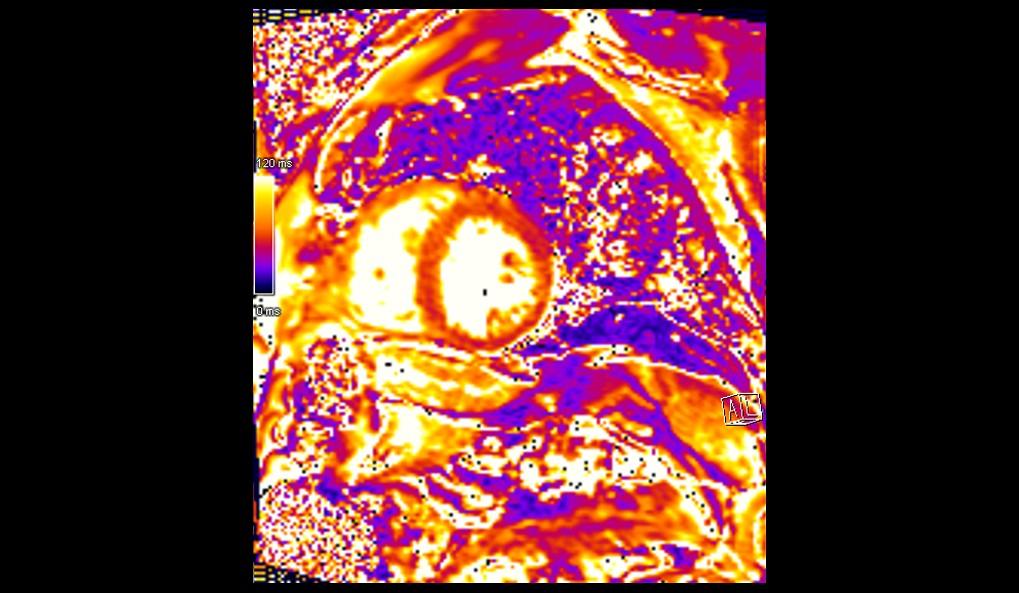 CT image of retro-ocular masses causing exophthalmos along with bilateral perinephric, pericardial, and pelvic exudates