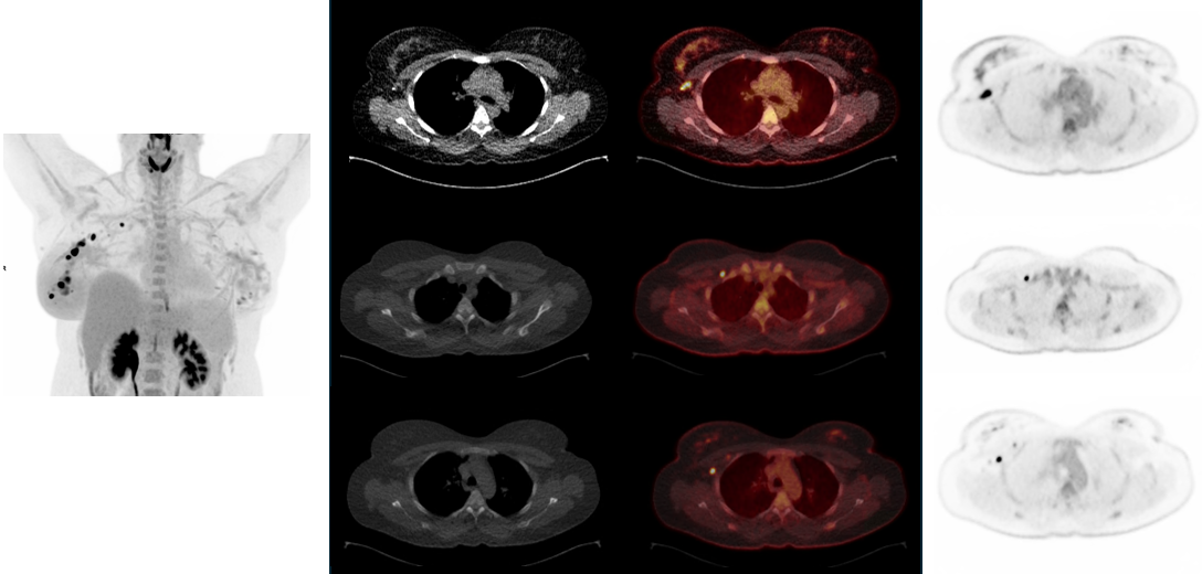 PET/CT in pregnant patients